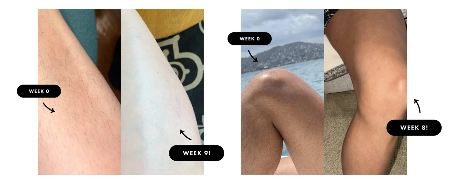 999900 Flashes IPL Hair Removal Safe Permanent Painless Epilator Face Body Arms Leg Whole Body Treament For Men Women Home Use